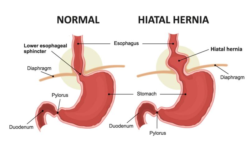 Hiatal Hernia